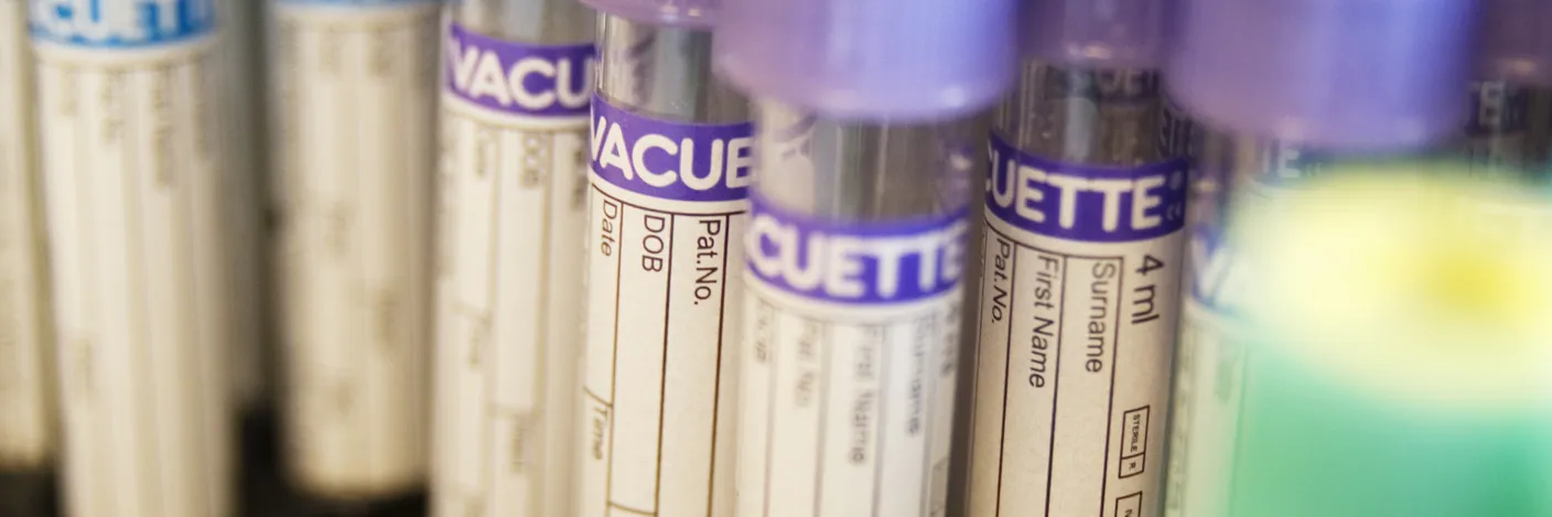 Blodprøveglass i forskjellige farger i et stativ.