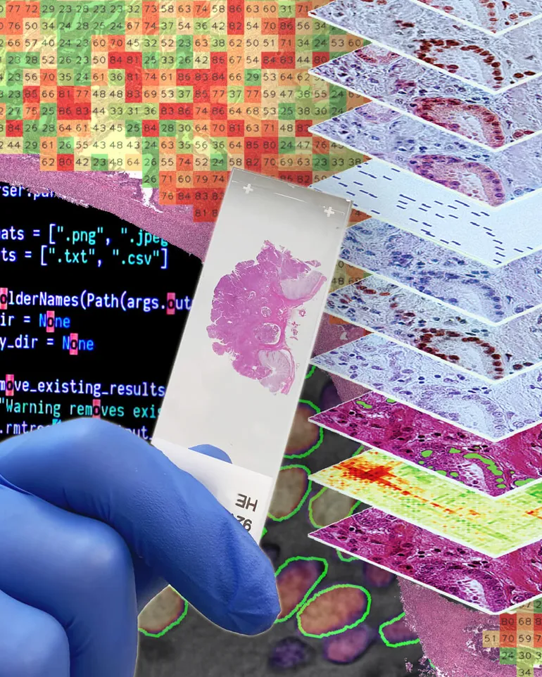Bildet viser et HE-farget snitt montert i glass, digitale innfargede og analyserte patologisnitt, histotyping og kodesnutter på en mørk skjerm