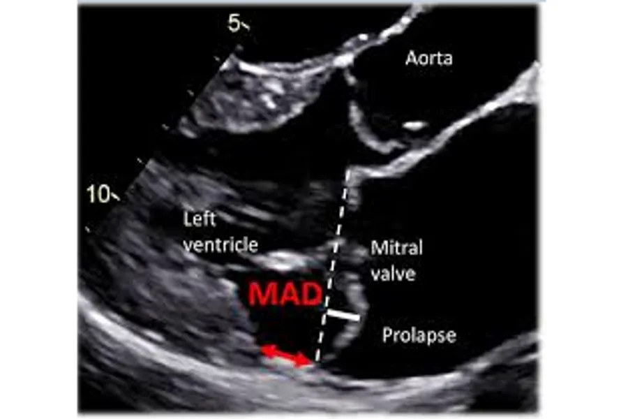 Echocardiography of mitral annulus disjunction