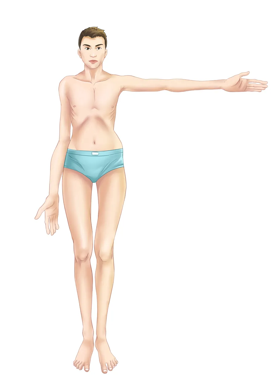 En tegning av en person med marfan iført badedrakt