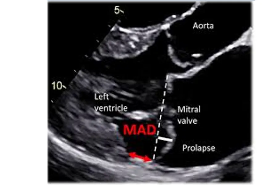 MVP/MAD on cardiac ultrasound