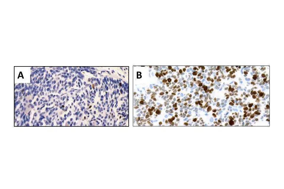 Dette bilde viser kreftceller i delingsfase, To bilder, a og b. Bilde A viser langsomtvoksende kreftceller, mens bilde B viser hurtigvoksende kreftceller (det vil vi mange celler som er i deling).