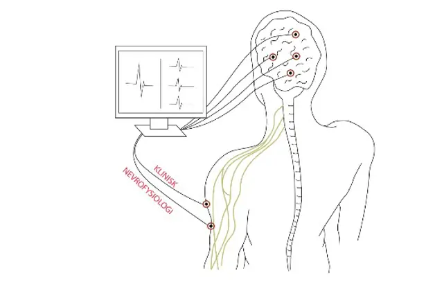 illustrasjonsbilde av elektroder på hodet og avlesning på skjerm