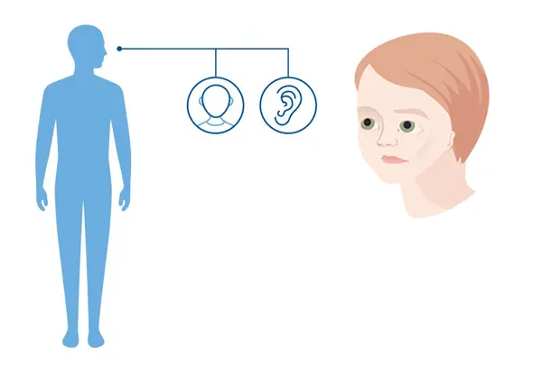 Diagnoseillustrasjon av en blå helkorppsfigur som viser hvilke kroppsdeler Craniofacial mikrosomi (OAVS) påvirker: Kraniet, øret