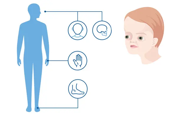 Diagnoseillustrasjon som viser et ansikt med grunne øyehuler som er typisk for Apert syndrom. 