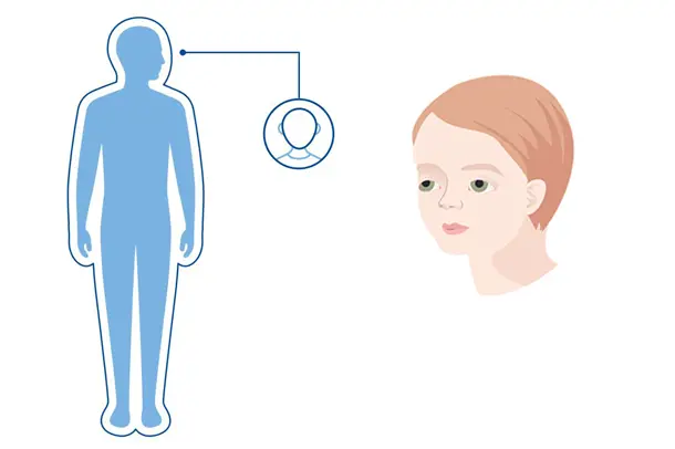 Illustrasjon av en blå menneskekropp med  et uthevet symbol av hodeskallen, som viser at Freeman-sheldon påvirker utseende. 