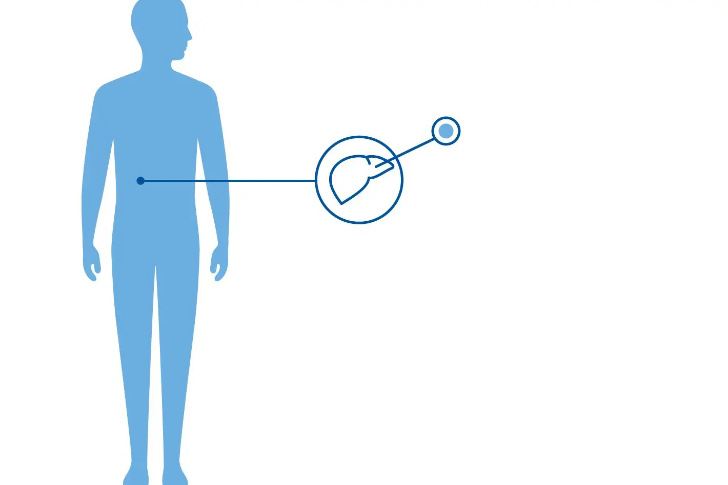 Illustrasjon av et menneske som viser hvor PKU påvirker kroppen