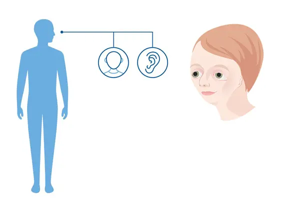 Diagnoseillustrasjon av hvilke kroppsdeler Treacher Collins syndrom påvirker: hodet og ører