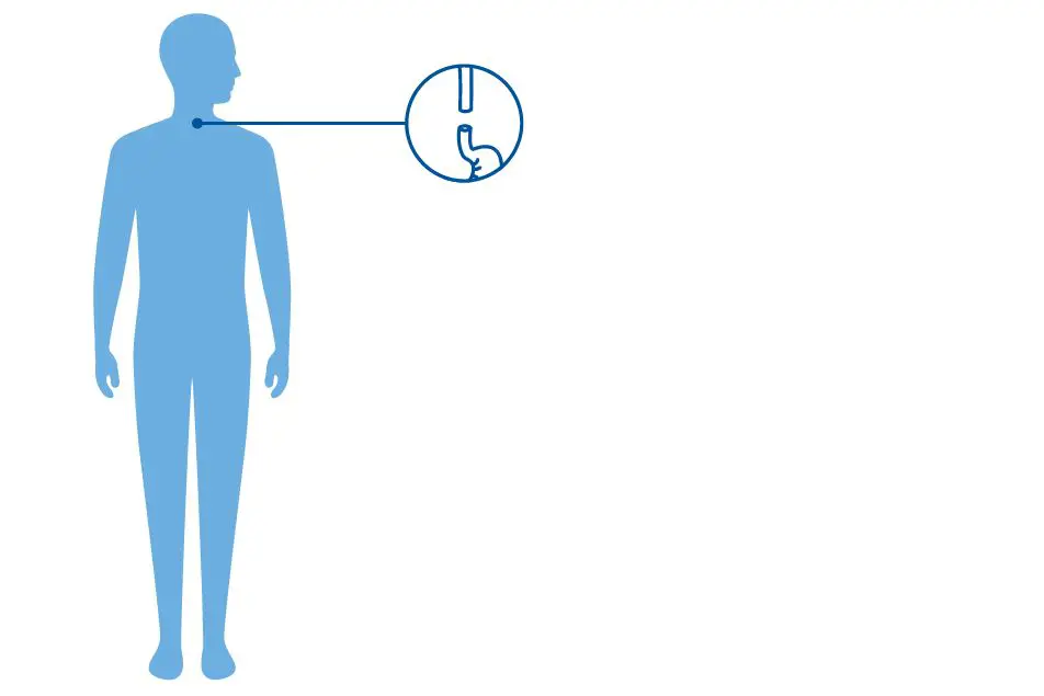 Illustrasjon av en blå menneskekropp og et ikon av  et delt spiserør, beskrivende for den sjeldne diagnosen øsofagusatresi