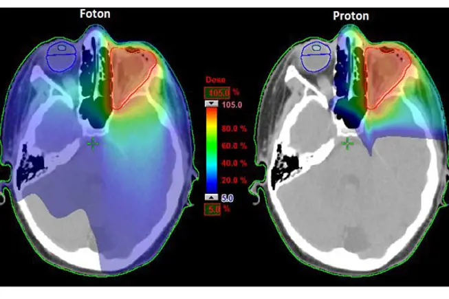 Bildet viser røntgenbilder av to hoder under vanlig strålebehandling og protonbehandling.