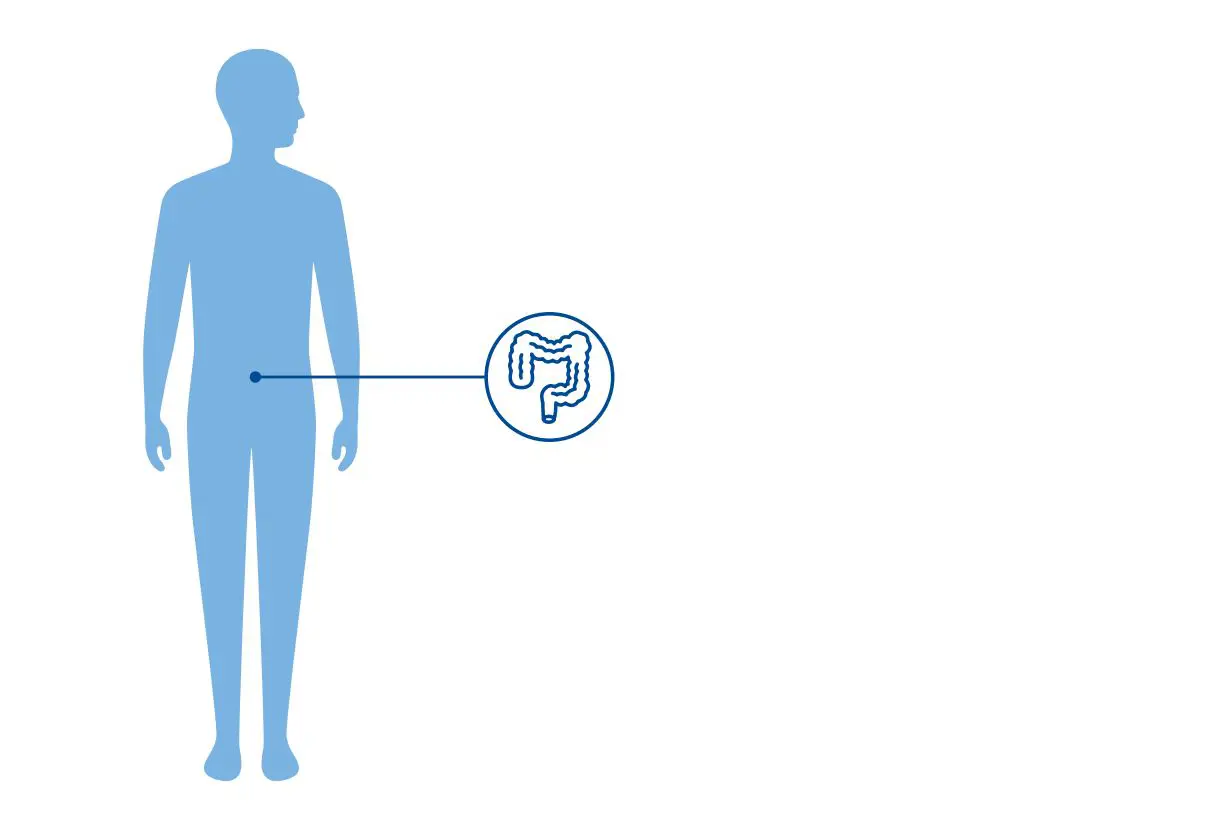 Illustrasjon av et menneske med et uthevet symbol av en tarm, dette viser at Currarino syndrom er en anorektal tilstand.