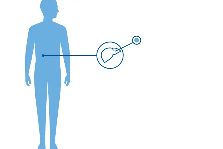 Diagnoseillustrasjn av Galatosemi