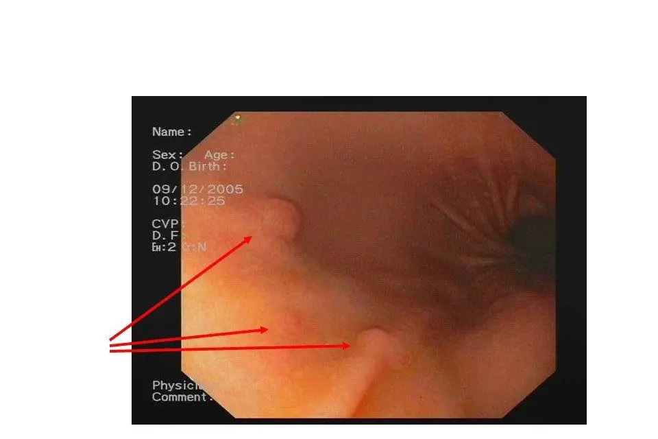 Bildet viser svulst i magesekken ifm gastroskopi