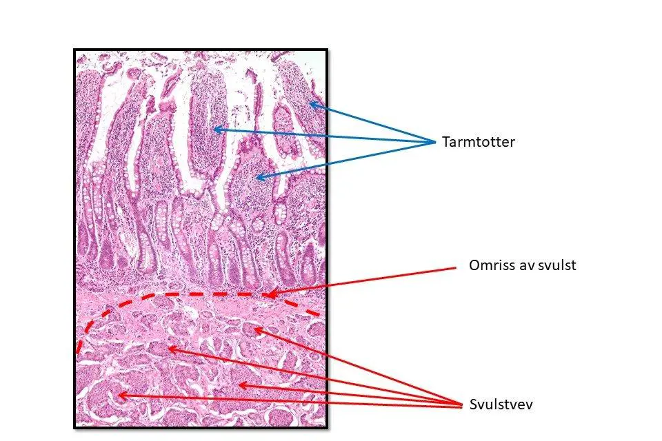 Bildet viser del av tynntarm med svulst sett gjennom mikroskopi