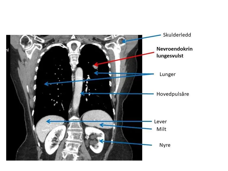 Bildet viser lengdesnittbilde av lunger og øvre del av magen med nevroendokrin lungesvulst