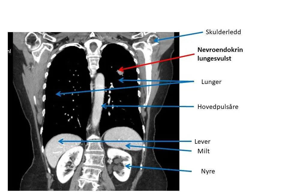 Bildet viser lengdesnittbilde av lunger og øvre del av magen med nevroendokrin lungesvulst