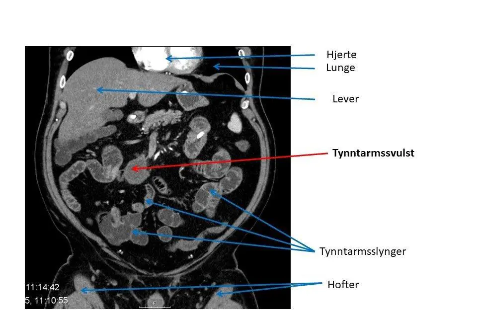 Bildet vuser CT spesialundersøkelse av tynntarm