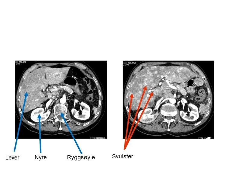 Bilde viser CT tverrsnitt gjennom leveren, hurtigvoksende