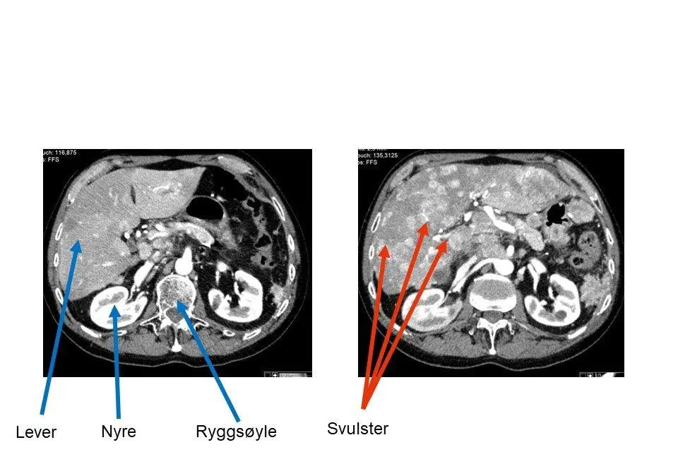 Bilde viser CT tverrsnitt gjennom leveren, hurtigvoksende