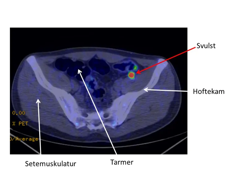 Bilde viser svulst i bekkenet ved Gallium-PET