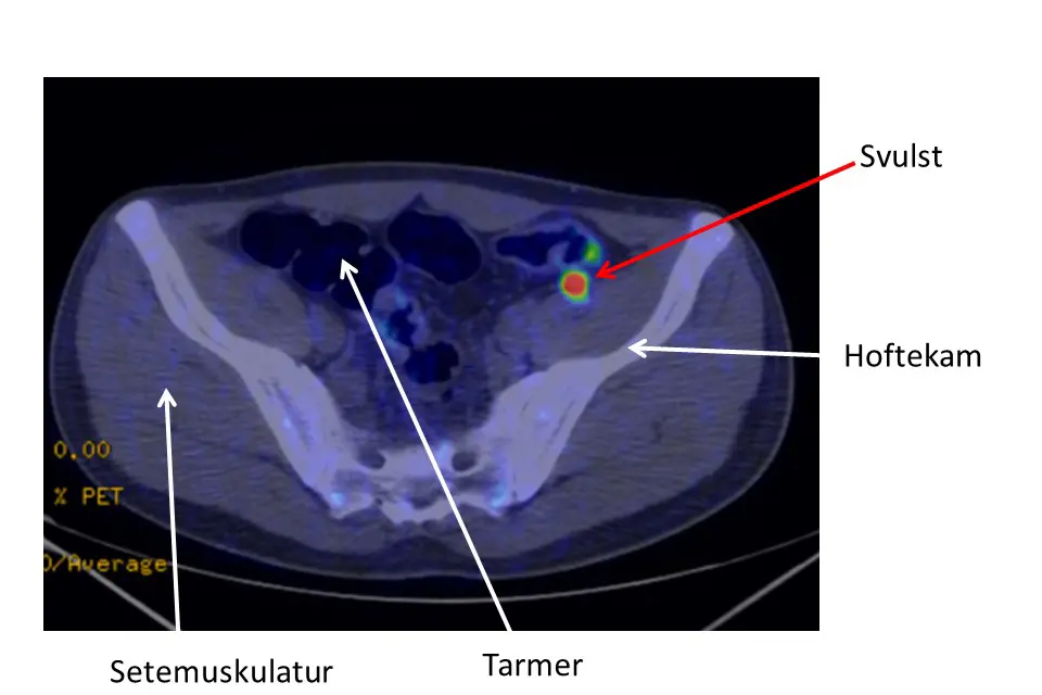Bilde viser svulst i bekkenet ved Gallium-PET