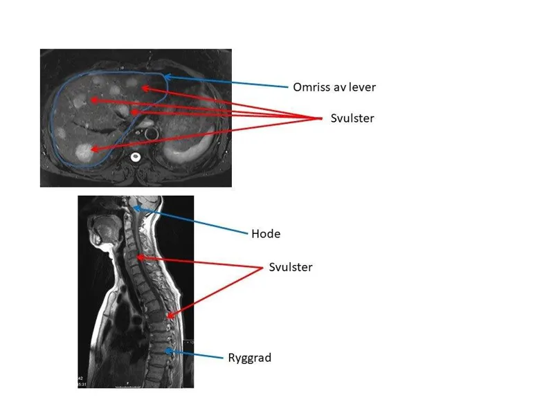 Bildet viser NR bilder av svulster i lever og ryggrad