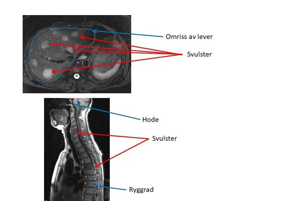 Bildet viser NR bilder av svulster i lever og ryggrad