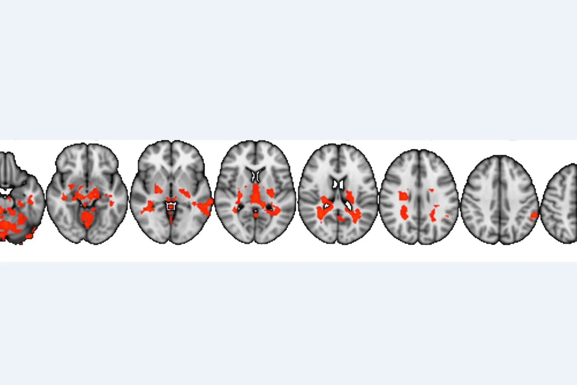 figur1: Hjernescanninger