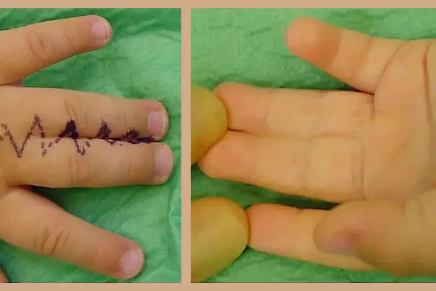 Bilde av to barnehender med sammenvoksning av fingre.
