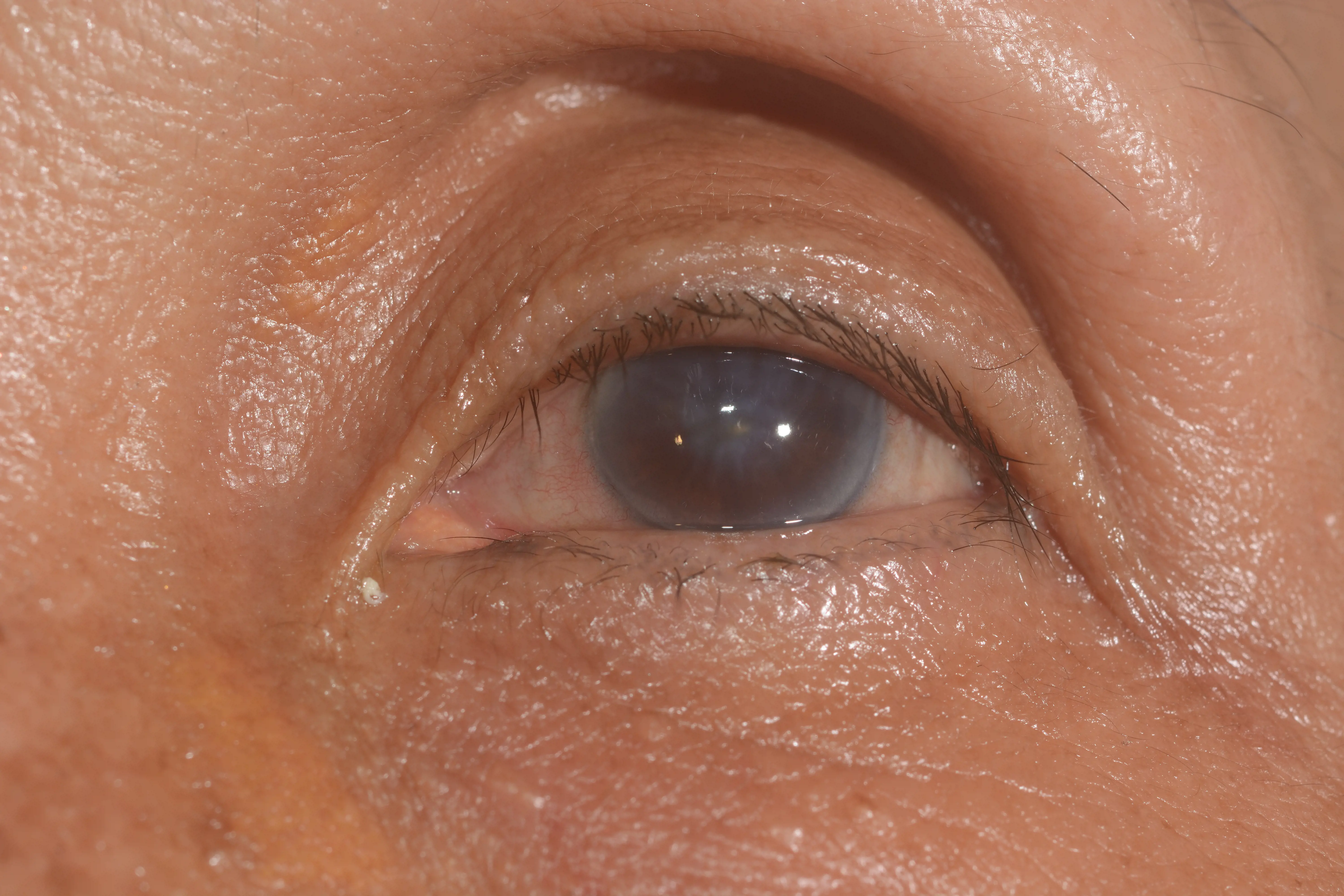 Nærbilde av et øye. Skille mellom hornhinne og pupill er uklar.