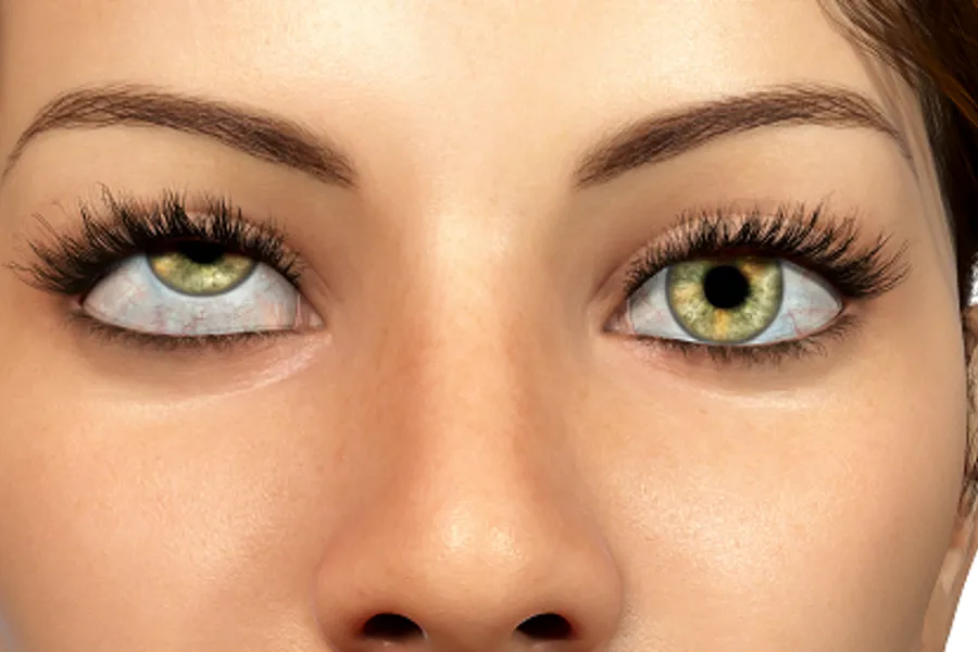 Illustrasjonsfoto av kvinne rammet av okulogyrisk krise, nærbilde av øyne