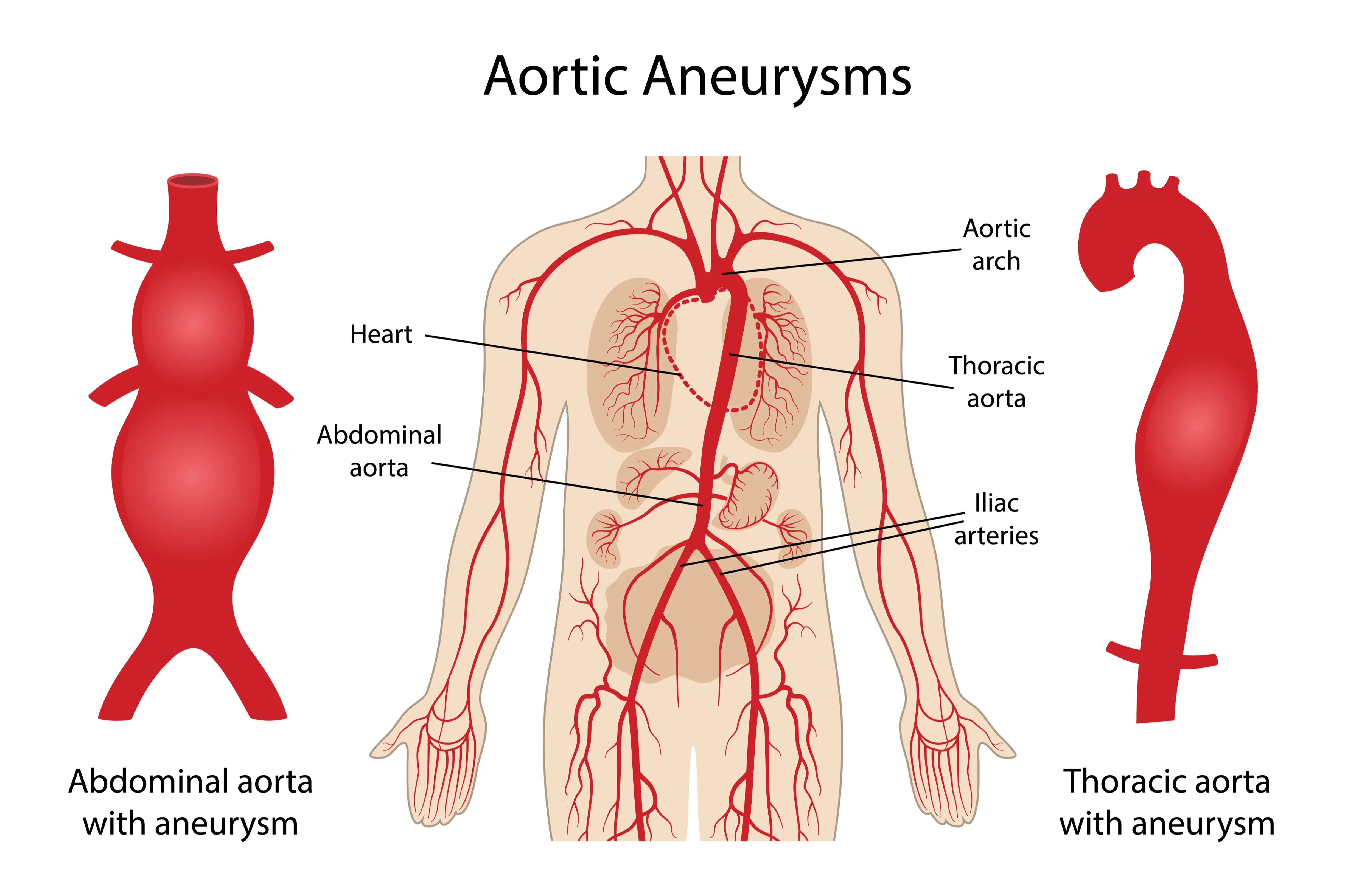Illustrasjon av aorta aneurisme