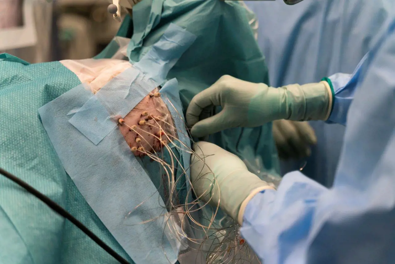 Bildet viser pasientens hode, der alle elektrodene er på plass.