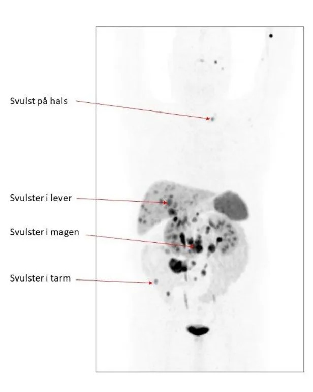 Bildet viser Gallium-PET som viser svulster i lever, hals, og i mage