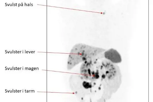 Bildet viser Gallium-PET som viser svulster i lever, hals, og i mage